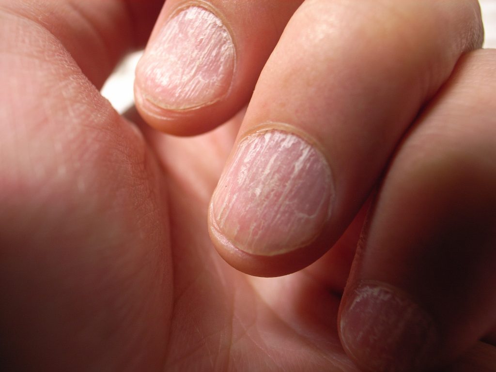Was Rillen in den Fingernägeln über die Gesundheit verraten AOZ