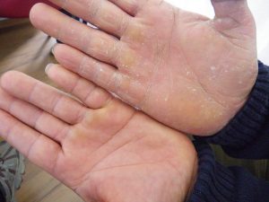 Beschädigte Hände im Wachsbad pflegen