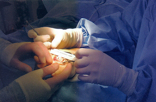 Operative Behandlung der Arthrose im Handgelenk