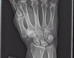 Das Röntgenbild zeigt Arthrose im Daumengelenk